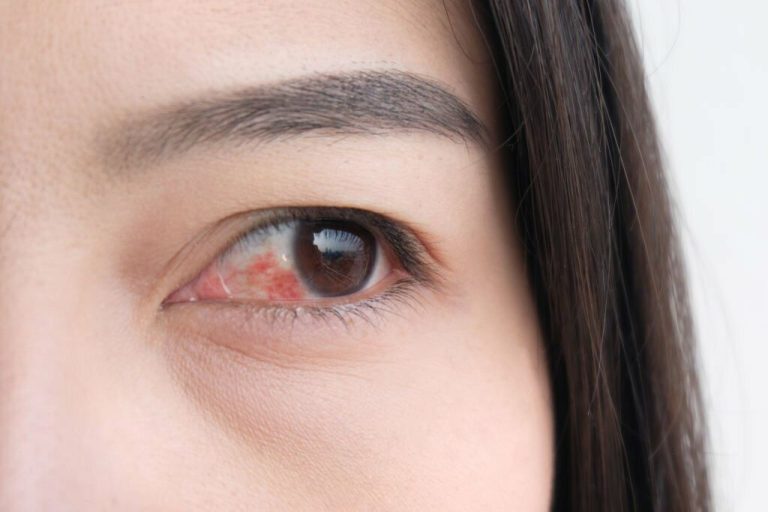 Why Are the Bottoms of My Eyes Red After Eyelash Extensions?