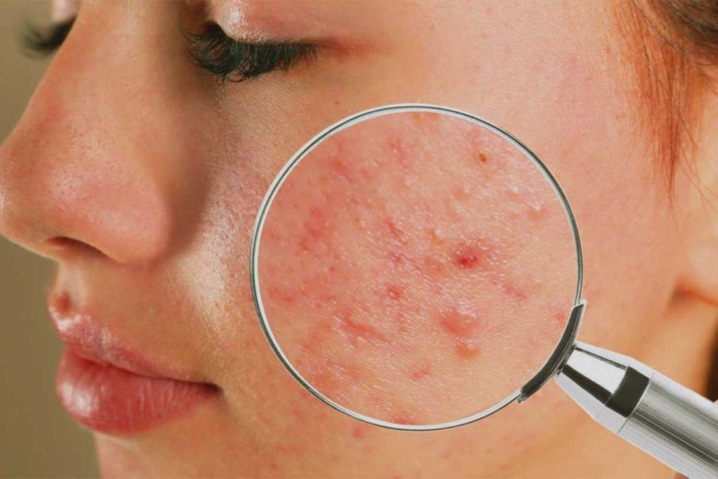 Determine If You Have Fungal Acne