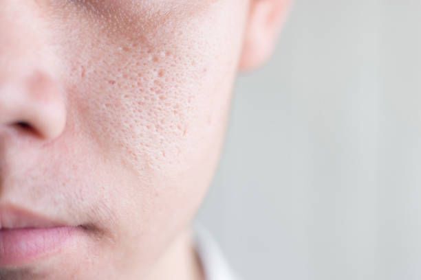 Enlarged Pore That Looks Like a Hole: Causes and  Treatment