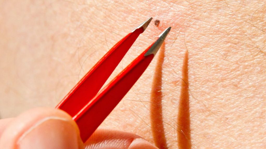 Ingrown hair after waxing treatment and preventions