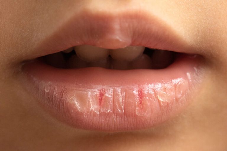 Why Do My Lips Peel Everyday? How To Prevent It?