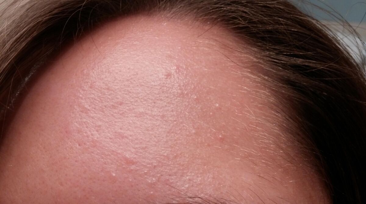 Is it closed comedones or fungal acne? A helpful Guide