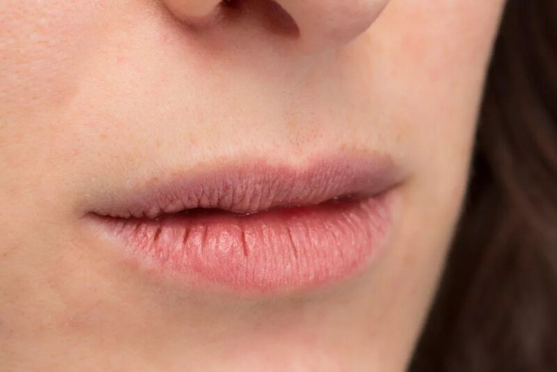 allergy might be causing your dry lips