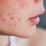 The Most Common Skin Complaints And How To Address Them