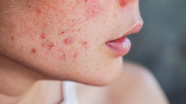 The Most Common Skin Complaints And How To Address Them