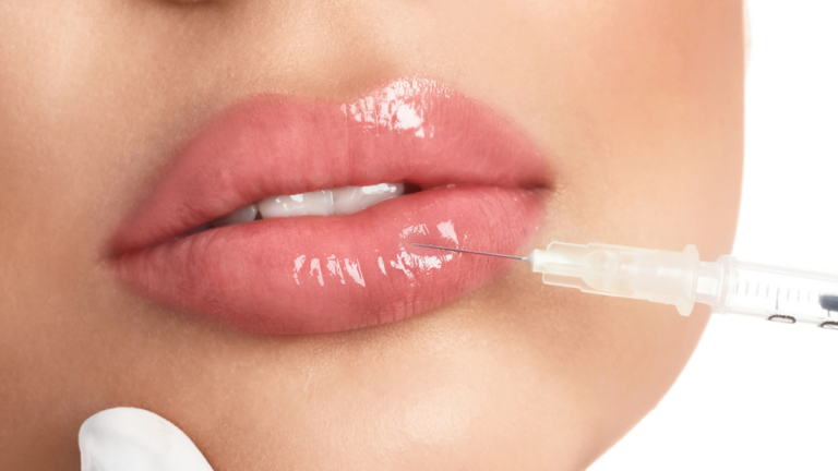 Luscious Lips: The Ultimate Guide to Lip Fillers